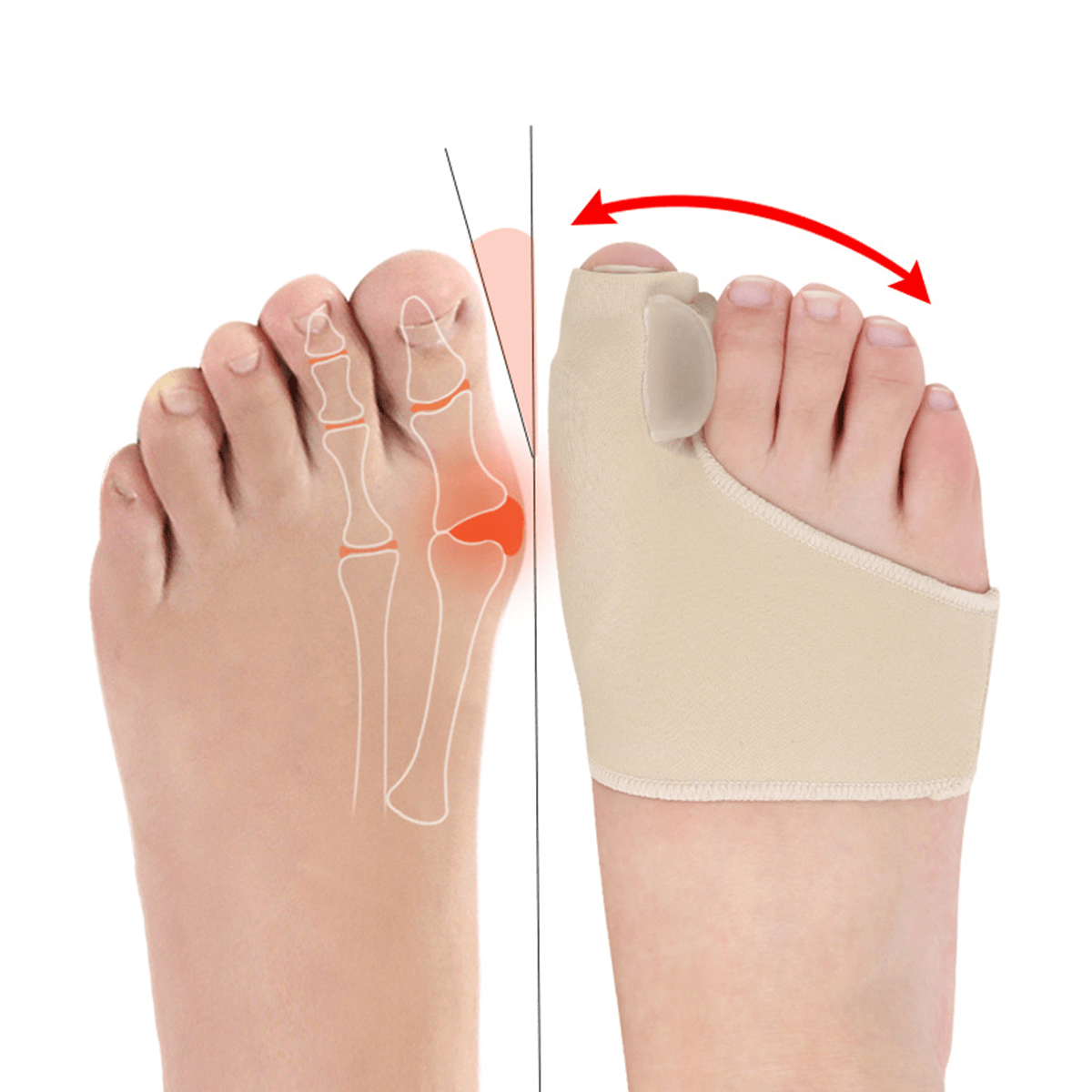 1 paire de protecteurs d'oignon, redresseurs, séparateurs, correcteurs, soins pour hallux valgus