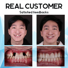 Natural-Looking Smile | Easy Home Dental Solution | Silicone Reline Denture Set