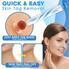 Skin Tag Removal Kit | Easy Band Application | At-Home Use | Fast Results |TagGone