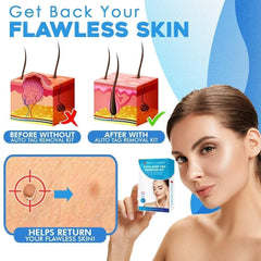 Skin Tag Removal Kit | Easy Band Application | At-Home Use | Fast Results |TagGone