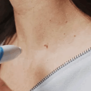 Skin Tag Removal Kit | Easy Band Application | At-Home Use | Fast Results |TagGone