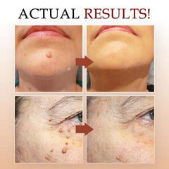 Skin Tag Remover | Fast-Acting Formula | Painless Application