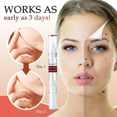 Skin Tag Remover | Fast-Acting Formula | Painless Application