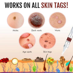 Skin Tag Remover | Fast-Acting Formula | Painless Application
