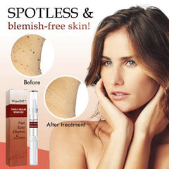 Skin Tag Remover | Fast-Acting Formula | Painless Application